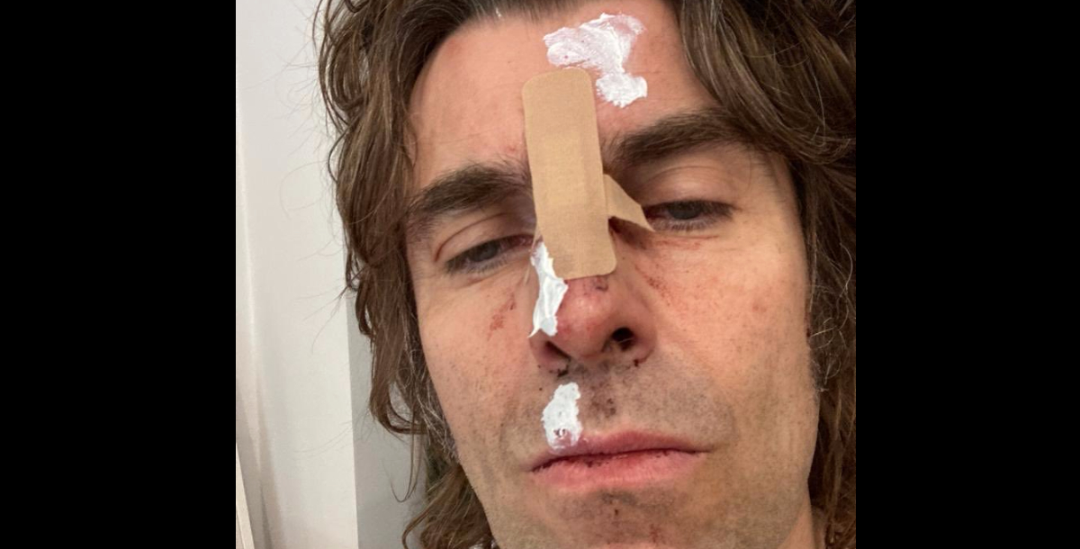 Liam Gallagher, incidente in elicottero per l’ex Oasis con il volto tumefatto