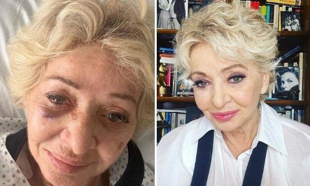 Enrica Bonaccorti si mostra con alcune ferite in viso: “Non mi ha menata nessuno. Sono caduta di faccia”