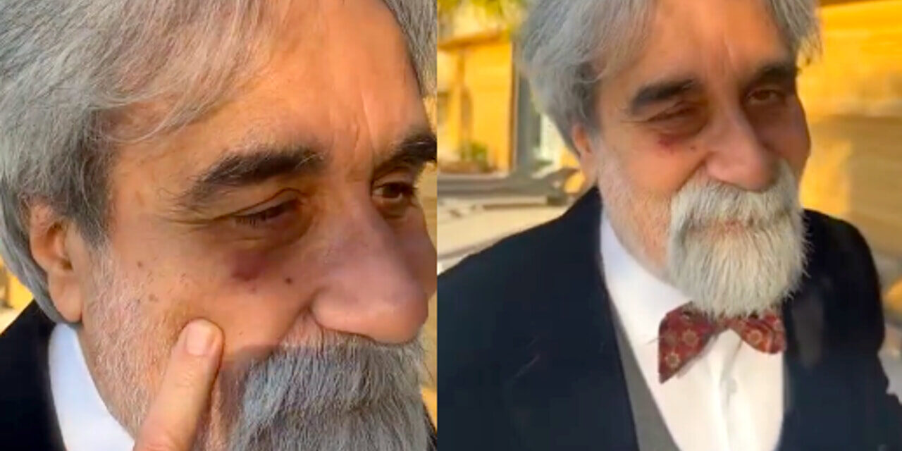 Beppe Vessicchio sbatte contro la vetrata della villa a Sanremo. Il livido all’occhio è virale