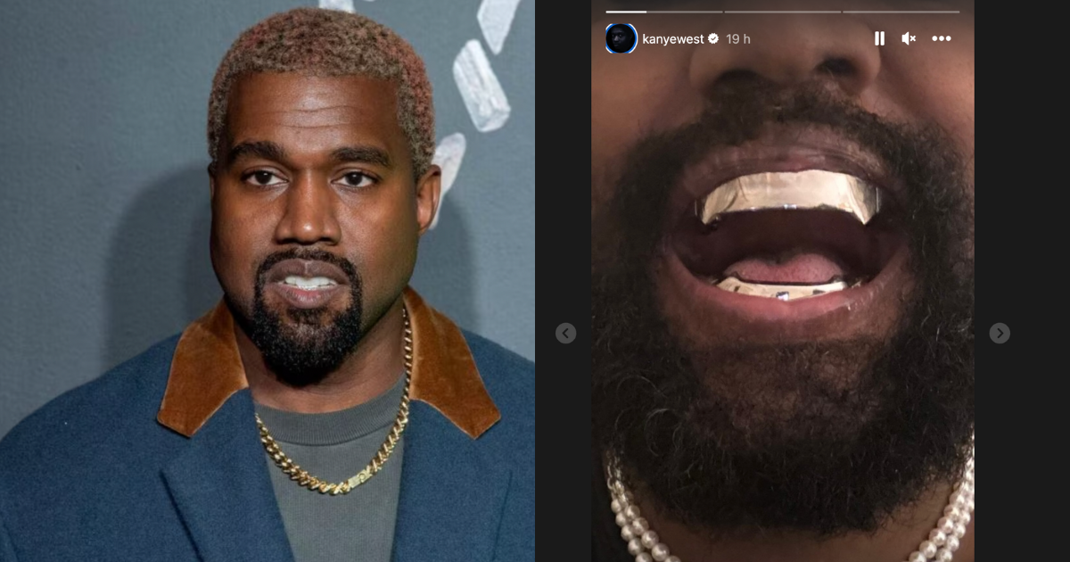 Kanye West si è fatto sostituire tutti i denti con una protesi al titanio da 850 mila dollari